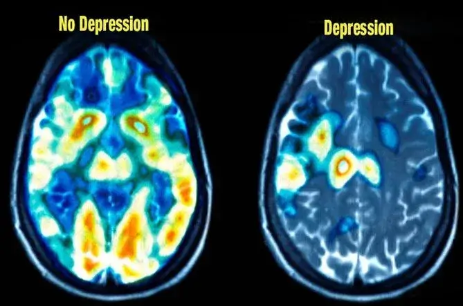 TMS Brain Scan Image